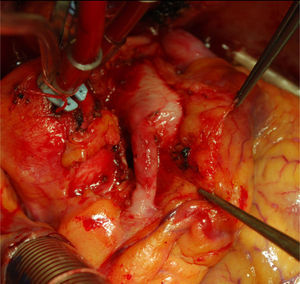 Imagen intraoperatoria de origen anómalo de la arteria coronaria derecha desde la arteria pulmonar.