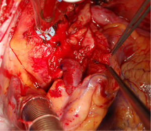 Imagen intraoperatoria donde se muestra la reimplantación de la arteria coronaria derecha en la arteria aorta.