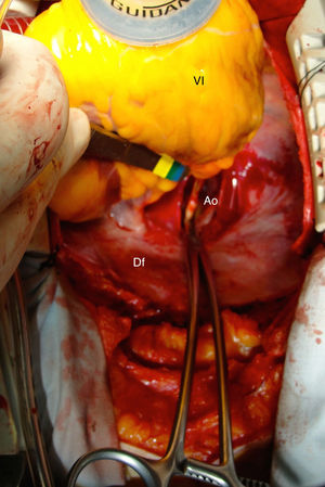 Pinzamiento de la aorta retrocardiaca. El corazón está levantado mediante un sistema de succión. Ao: aorta descendente; Df: diafragma; VI: ventrículo izquierdo.