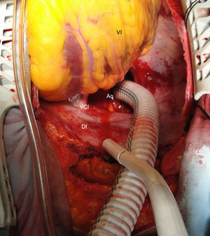 Injerto de dacrón anastomosado a la aorta descendente: se observa la cava inferior disecada. Ao: aorta descendente; Df: diafragma; VCI: vena cava inferior; VI: ventrículo izquierdo.