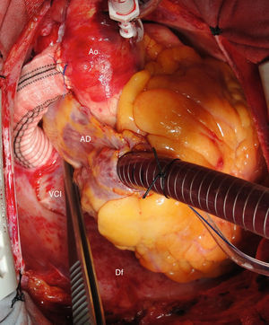 Anastomosis del injerto a la cara lateral derecha de la aorta ascendente. Obsérvese el trayecto del injerto por detrás de la cava inferior, ampliamente disecada. AD: aurícula derecha; Ao: aorta descendente; Df: diafragma; VCI: vena cava inferior.