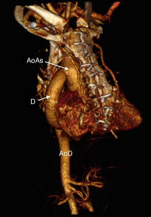 Imagen de la anastomosis proximal a los 3 meses de la intervención. AoAs: aorta ascendente; AoD: aorta descendente; D: prótesis de dacrón.