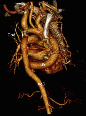 Imagen de la anastomosis distal a los 3 meses de la intervención. Se aprecia igualmente el segmento de la coartación. AoD: aorta descendente; CoA: coartación; D: prótesis de dacrón.