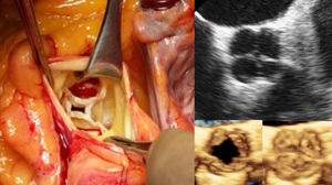 En estas imágenes se aprecia la evaluación quirúrgica de la válvula aórtica donde se objetivaron 4 velos, 2 de ellos del mismo tamaño, el coronariano izquierdo (VCI) y el no coronariano (VNC), y otros 2 velos diferentes, el coronariano derecho (VCD) y el velo accesorio, y las imágenes ecocardiográficas correspondientes, en 2D y su reconstrucción en 3D.