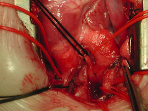 Arco aórtico derecho y doble ligamento ductal intervenido mediante esternotomía media.