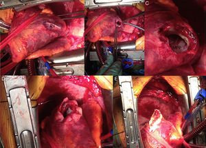 Anatomía quirúrgica y técnica de Dor modificada para reparación del seudoaneurisma ventricular izquierdo. A, B y C: apréciese la correspondencia con las pruebas de imagen (Figuras 1 y 2.), quedando el defecto de rotura transmural de la pared ventricular con músculo “fresco” (C) tan solo contenido por una capa de epicardio que se invagina con la presión negativa intraventricular ya en circulación extracorpórea (A). D y E: técnica de Dor modificada con una primera ventriculorrafia circular apoyada en parche de pericardio bovino y posterior cierre hemostático con una segunda capa de sutura continua también apoyada en pericardio bovino. MPP: músculo papilar posterior. Ps: seudoaneurisma de ventrículo izquierdo.