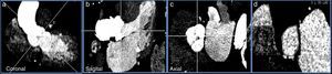 Imagen con contraste de TCMD de paciente con estenosis aórtica grave. Planco coronal (a) y sagital (b) del tracto de salida de ventrículo izquierdo, porción sinusal y aorta ascendente. c) Imagen de la raíz aórtica a nivel de los senos de Valsalva. d) Anillo de la válvula aórtica donde se realizarán las medidas necesarias para la selección del tamaño de la prótesis percutánea aórtica.