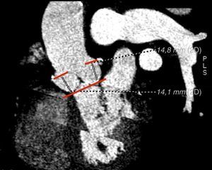 Planco coronal con contraste del TCMD de la raíz aórtica y la aorta ascendente en el que se realiza medición de la distancia desde el plano del anillo aórtico hasta el origen del ostium del tronco común izquierdo (14,8mm) y ostium arteria coronaria derecha (14,1mm).