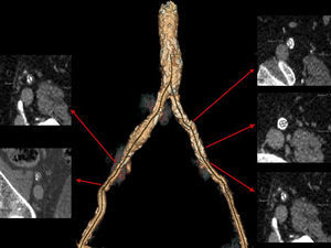 Reconstrucción tridimensional de la angiografía vascular arterial de MMII por TCMD a nivel ileofemoral. Se observa la presencia de abundante arterioesclerosis, con presencia de estenosis y dilataciones aneurismáticas posteriores a las estenosis.