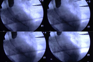 Varias secuencias del implante previa aortografía e inflado lento que permite pequeños ajustes de la prótesis. Se observan de manera muy nítida el plano valvular y las arterias coronarias.