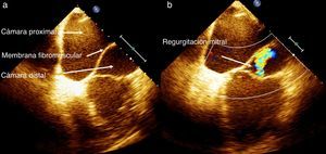 Ecocardiografía transesofágica. a) Muestra la aurícula izquierda dividida por una membrana en una cámara posterior y una anterior (cor triatriatum). b) Regurgitación mitral central (área 5 cm2).