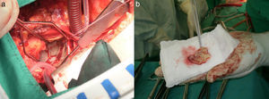 Resultados de la cirugía realizada al paciente (primera parte). a) Luego de la auriculotomía izquierda se encontró una gruesa membrana fibromuscular que dividía la aurícula izquierda en 2 compartimentos. b) La membrana fue resecada en su totalidad, convirtiendo la aurícula izquierda en una cavidad unicameral.