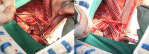 Resultados de la cirugía realizada al paciente (segunda parte). a) Fueron reparadas 2 pequeñas hendiduras en el velo anterior de la válvula mitral con puntos de prolene 4/0 y soportes de teflón. b) Luego de terminada la reparación se muestra la válvula mitral competente.