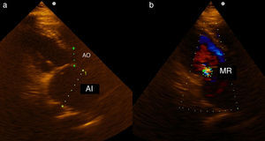 Muestra el resultado de la ecocardiografía transtorácica realizada un año después de la cirugía. a), conversión de la aurícula izquierda en una cavidad unicameral. b), presencia de una regurgitación mitral ligera (área de 0,93 cm2).