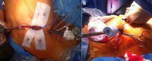 A) Incisión torácica. Separador quirúrgico de partes blandas. B) Introducción del trócar con la óptica de toracoscopia de 30°.