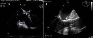 A) Plano medioesofágico válvula aórtica eje largo 120°. Hematoma periaórtico tras administración de cardioplejia intramural. B) Plano medio esofágico 4 cámaras. Evidencia de balón introduciéndose en seno coronario a nivel de auricula derecha.