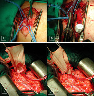 Imágenes intraoperatorias de disección inguinal izquierda (A), con vena medial y arteria lateral, posteriormente con las cánulas colocadas en dichos vasos (B), para iniciar la circulación extracorpórea. Interposición de bioprótesis pulmonar (C), con techo de vena yugular bovina (D).