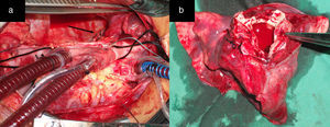 a) La figura ilustra la exéresis de lóbulo inferior del pulmón derecho. La flecha negra señala el sitio de la sutura en el bronquio. b) El examen macroscópico del lóbulo inferior derecho resecado puso de manifiesto la presencia de una cavidad llena de sangre.