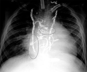 Radiografía pretrasplante mostrando múltiples embolizaciones previas así como stents en la arteria pulmonar izquierda (óvalo horizontal) y vena cava inferior (óvalo vertical) en el conducto extracardiaco (paciente n.° 2).