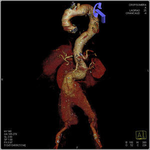 Reconstrucción rendering de una angio-TAC, donde se observa elongación de aorta torácica y abdominal, y aneurisma de aorta abdominal yuxtarrenal roto, que se extiende hasta las arterias ilíacas.