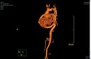 Se observa, en toda su extensión, el injerto aórtico desde la aorta ascendente a la aorta descendente supradiafragmática.