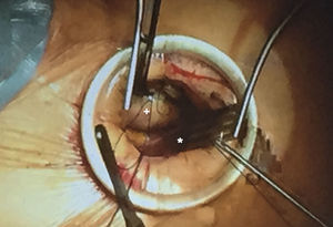 Imagen operatoria de MTA por 2.° EICD, visión del cirujano. Asterisco (*): orejuela de AD; signo de suma (+): aorta ascendente. Cedido por el Dr V. Bapat.