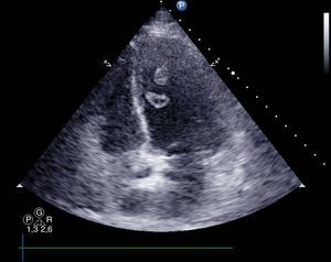 Ecocardiograma transtorácico: trombo apical objetivado en plano de 4 cámaras.
