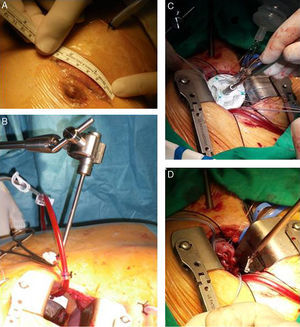 Imágenes operatorias de minitoracotomía anterior derecha. A) Minitoracotomía anterior derecha de 6cm, 1cm inferior a la mamila. B) Separador auricular a través de puerto accesorio y cánula en raíz aórtica para cardioplejía. C) Visión del cirujano durante implante valvular. D) Detalle bajador de nudos.
