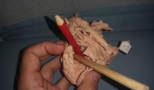Modelo 3D. Glenn. Ventrículo izquierdo de doble salida.