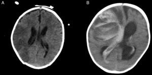 Imágenes de tomografía computarizada craneal mostrando infarto cerebral isquémico (A) y hemorragia cerebral severa (B) en pacientes portadores de BH, que causaron su muerte hospitalaria.