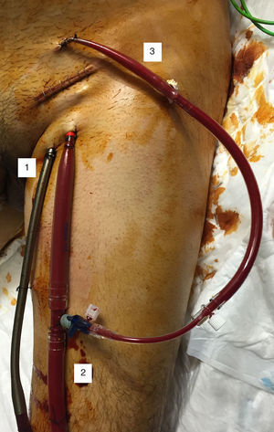 ECMO venoarterial periférico con canulación femorofemoral. 1: cánula venosa de drenaje; 2: cánula arterial de retorno; 3: cánula de perfusión distal del miembro.