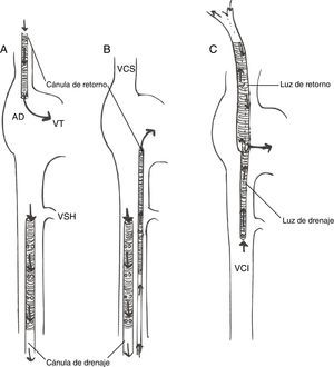 Configuraciones de cánula en ECMOVV. A: canulación femoroyugular; B: canulación femorofemoral; c: canulación con cánula única de doble luz. AD: aurícula derecha; VCI: vena cava inferior; VCS: vena cava superior; VSH: vena suprahepática; VT: válvula tricúspide.
