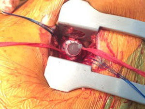 Implante de cánula de descarga en ápex ventricular izquierdo por minitoracotomía anterior izquierda (se utiliza el sewing ring de la cánula de drenaje del Levitronix).