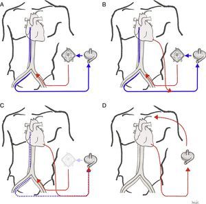 Paso de ECMOVA periférico a DAVI paracorpóreo tipo CentriMag Levitronix. A: ECMOVA femorofemoral; B: canulación apical del ventrículo izquierdo y descarga del ventrículo izquierdo (conexión a la línea de drenaje de la ECMO); C: retirada de cánula venosa femoral de drenaje (asegurar recuperación función ventricular derecha) y del oxigenador del circuito; D: canulación de la arteria axilar para facilitar la movilización y el cambio de la bomba por una de tipo Levitronix.