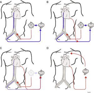 Paso de ECMOVA periférico a DAVI paracorpóreo tipo CentriMag Levitronix. A: ECMOVA femorofemoral; B: canulación apical del ventrículo izquierdo y descarga del ventrículo izquierdo (conexión a la línea de drenaje de la ECMO); C: retirada de cánula venosa femoral de drenaje (asegurar recuperación función ventricular derecha) y del oxigenador del circuito; D: canulación de la arteria axilar para facilitar la movilización y el cambio de la bomba por una de tipo Levitronix.