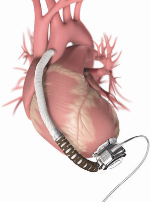 Esbozo de un dispositivo de asistencia ventricular izquierda DAVI tipo HVAD (HeartWare Inc.).