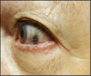 Pigmentación negra de la esclera ocular.