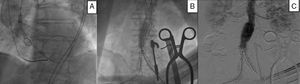 Caso 1. Tratamiento endovascular simultáneo. A) Reemplazo valvular aórtico endovascular. B) Reparación endovascular de aneurisma de aorta. C) Aortograma de control que evidencia exclusión del aneurisma, permeabilidad de ambas renales, sin fuga de contraste.
