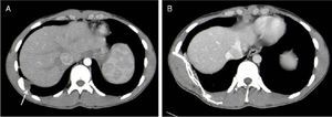 Imágenes axiales de la TC de tórax, tras la quimioterapia neoaduyuvante (A), apreciándose disminución del tamaño tumoral (flecha), y tras la resección quirúrgica (B).
