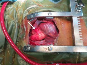 Imagen quirúrgica: hemitruncus con origen anómalo de la arteria pulmonar izquierda desde la aorta. Flecha: arteria pulmonar izquierda.