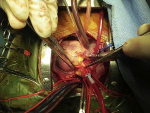 Imagen quirúrgica: sección de arteria pulmonar izquierda.