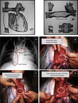 Trasplante tras cirugía de Fontan extracardíaco. Esquema: aspecto externo pre-trasplante del recetor (stent en ramas pulmonares) y campo quirúrgico poscardiectomía (plastia pulmonar hilio-hilio previa a implantación del corazón donante). Imagen intraoperatoria (A-D): extracción de stent en conducto extracardíaco de Fontan previo al TC.