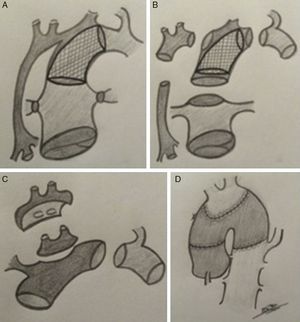 Esquema de estrategia quirúrgica de TC neonatal en receptor con atresia aórtica e hipoplasia de arco. A) Anatomía pre-TC. Abordaje híbrido (bibanding y stent ductal). B) Se muestran las estructuras por separado: aorta (2mm), arco, tronco pulmonar, stent ductal y aorta torácica descendente. C) Implantación de injerto libre de arco donante tras aislar el casquete de troncos supra-aórticos del receptor (parche de Carrell). D) Resultado final (anastomosis arco donante con aorta donante).