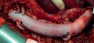 Aneurisma toracoabdominal tipo I (injerto multirrama woven dacron 30 mm). Las flechas muestran la dirección del flujo en el injerto snake. AMS: arteria mesentérica superior; TC: tronco celíaco.