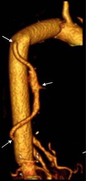 Control con tomografía axial computarizada de TS. Las flechas marcan la anastomosis proximal y distal de TS, así como una de las arterias intercostales permeables reimplantadas.