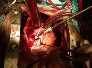 Imagen quirúrgica: apertura de aurícula izquierda. Flecha: colector pulmonar en cara posterior de aurícula izquierda.