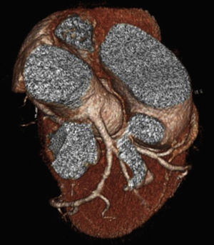 Angio-TAC coronaria. Véase la salida de la arteria coronaria derecha desde el tronco coronario izquierdo.