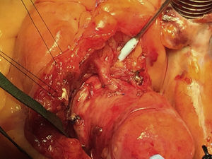 Anastomosis entre la arteria coronaria anómala y la aorta.