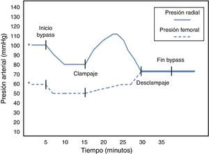 Gráfico de modificaciones hemodinámicas durante la perfusión (pre y posreparación). Se observa una caída inicial global en las presiones secundaria a la hemodilución, con recuperación posterior. Tras despinzamiento, ambas presiones se igualan.