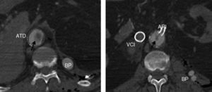 Tomografía axial computarizada. Trombo flotante (flechas) en transición toracoabdominal. ARI: arteria renal izquierda; ATD: aorta torácica descendente; BP: bypass (permeable); VCI: vena cava inferior (con stent ocluido).